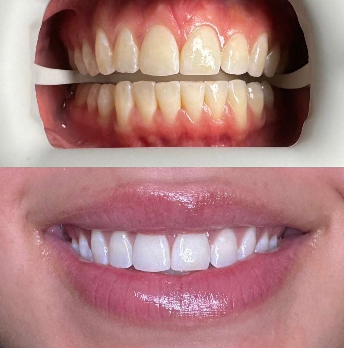at home teeth whitening trays